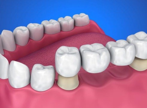 Dental Bridges Leicester - Treatment - Aesthetic Smiles Dental