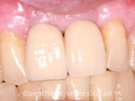 After - aestheticsmilesdental