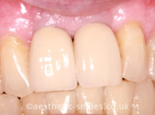 After - Aesthetic Smiles Dental