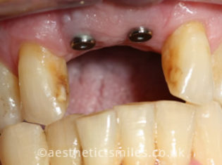 Before - Aesthetic Smiles Dental