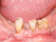 Before - aestheticsmilesdental