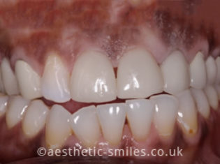 After - Aesthetic Smiles Dental