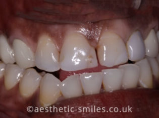 Before - Aesthetic Smiles Dental