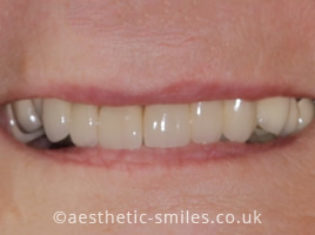 After - Aesthetic Smiles Dental