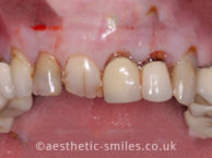 Before - aestheticsmilesdental