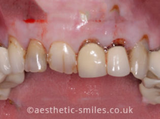 Before - Aesthetic Smiles Dental