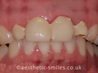 Before - aestheticsmilesdental