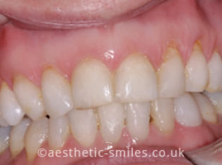 After - Aesthetic Smiles Dental