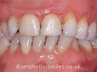 Before - aestheticsmilesdental