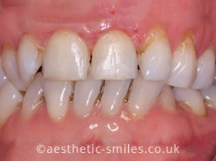 Before - Aesthetic Smiles Dental