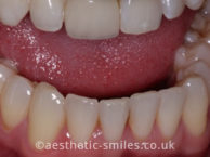 After - aestheticsmilesdental