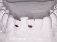 Before - aestheticsmilesdental