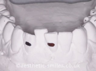 Before - Aesthetic Smiles Dental