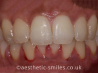 After - aestheticsmilesdental