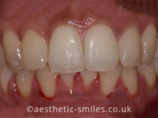 After - Aesthetic Smiles Dental