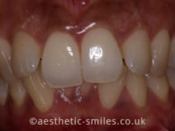 Before - aestheticsmilesdental