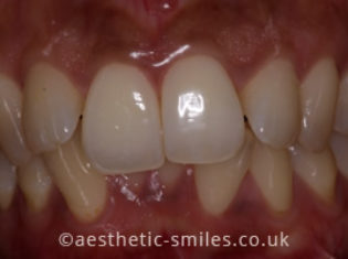 Before - Aesthetic Smiles Dental