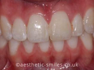 After - Aesthetic Smiles Dental