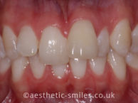 Before - aestheticsmilesdental