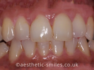 Before - Aesthetic Smiles Dental