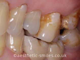 After - Aesthetic Smiles Dental