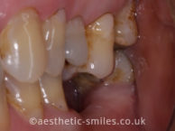 Before - aestheticsmilesdental