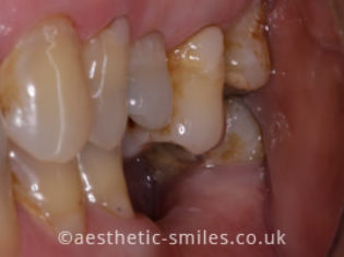 Before - Aesthetic Smiles Dental