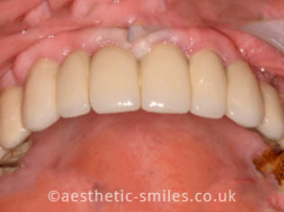 After - Aesthetic Smiles Dental