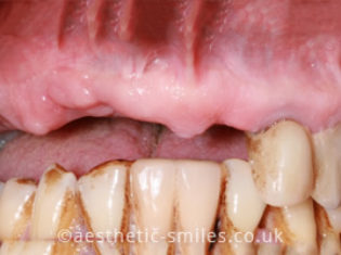 Before - Aesthetic Smiles Dental