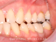 After - aestheticsmilesdental