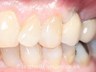 After - aestheticsmilesdental