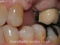 Before - aestheticsmilesdental