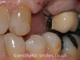 Before - Aesthetic Smiles Dental