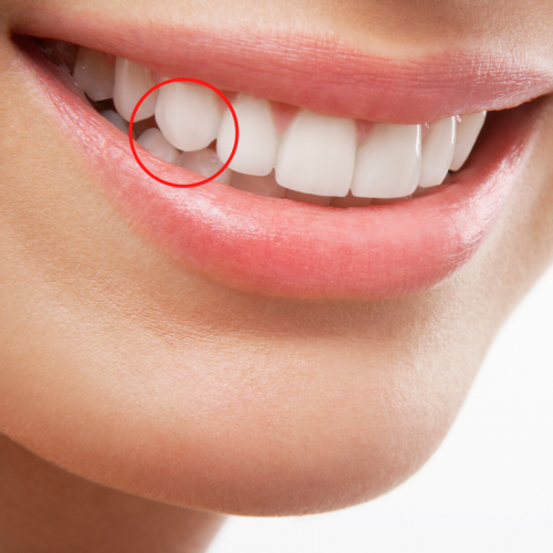 Teeth contouring, reshaping and shaving Dental Blog Aeshetic Smiles